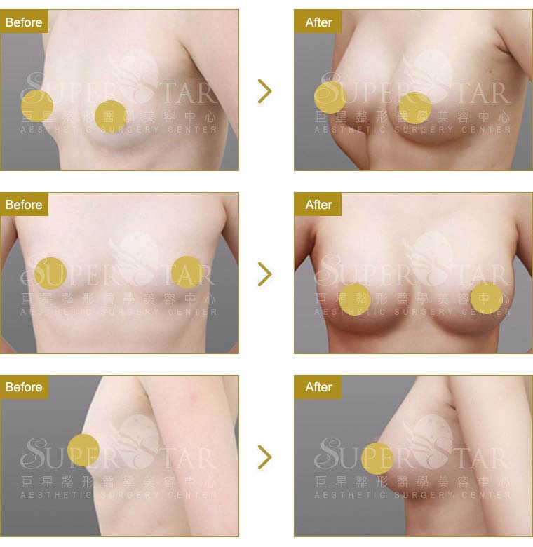 Case 3: 全程內視鏡腋下隆乳 | AA 罩杯 ⇒ C 罩杯