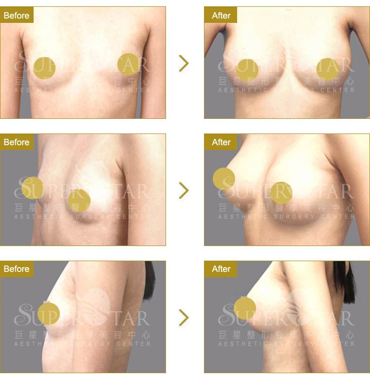 Case 4: 全程內視鏡腋下隆乳 | A 罩杯 ⇒ D 罩杯