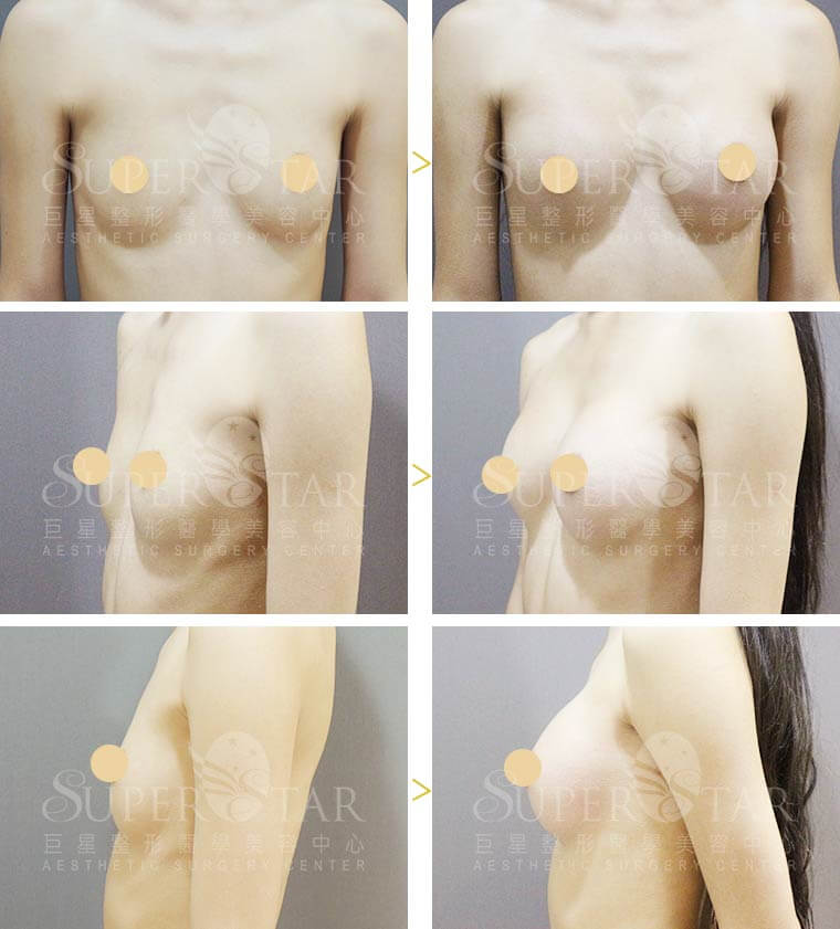 Case 5: 全程內視鏡腋下隆乳 | AA 罩杯 ⇒ C 罩杯