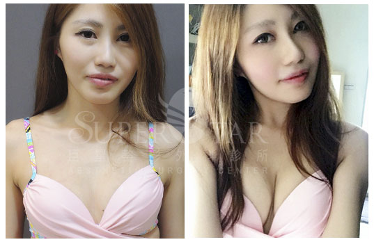 Case 6: 全程內視鏡腋下隆乳 | A 罩杯 ⇒ 大 C 罩杯