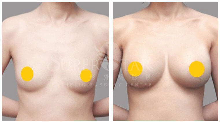 Case 7: 全程內視鏡腋下隆乳 | A 罩杯 ⇒ D 罩杯1