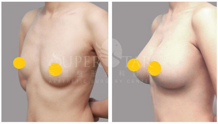 Case 7: 全程內視鏡腋下隆乳 | A 罩杯 ⇒ D 罩杯2