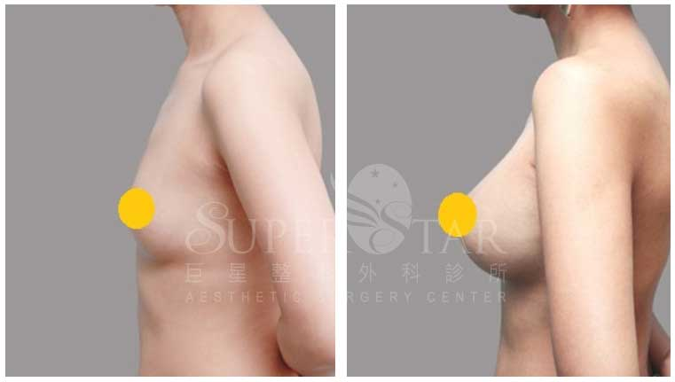 Case 7: 全程內視鏡腋下隆乳 | A 罩杯 ⇒ D 罩杯3