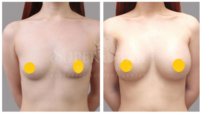 Case 8: 全程內視鏡腋下隆乳 | A 罩杯 ⇒ D 罩杯