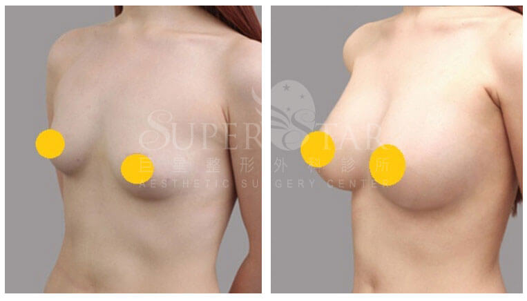 Case 8: 全程內視鏡腋下隆乳 | A 罩杯 ⇒ D 罩杯2