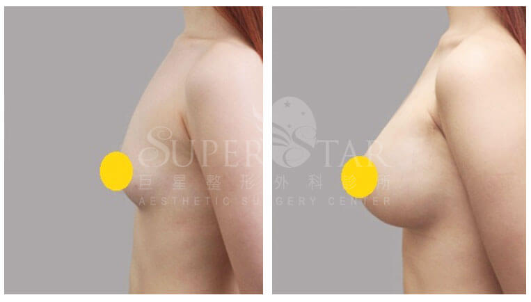 Case 8: 全程內視鏡腋下隆乳 | A 罩杯 ⇒ D 罩杯3
