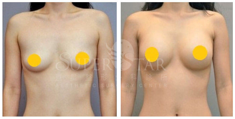 Case 9: 產後乳房萎縮 / 產後乳房下垂 | 全程內視鏡腋下隆乳 A ⇒ 大 C