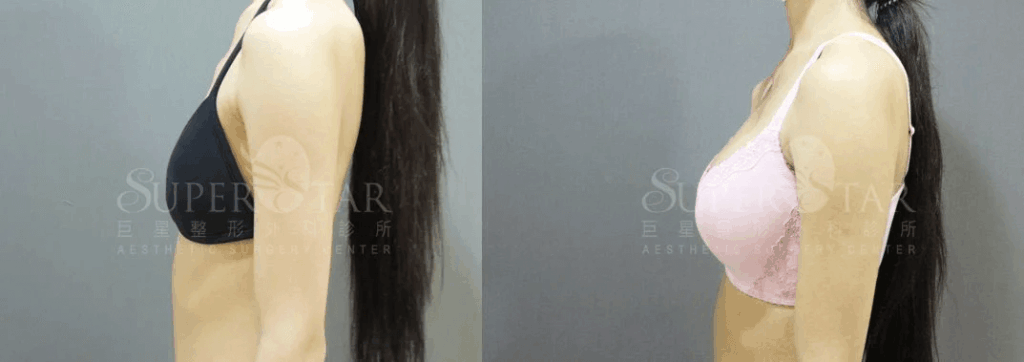 Case 10: 全程內視鏡腋下隆乳 | AA 罩杯 ⇒ C 罩杯1