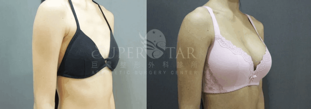 Case 10: 全程內視鏡腋下隆乳 | AA 罩杯 ⇒ C 罩杯2