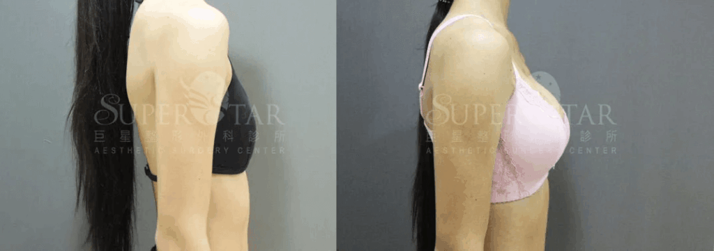 Case 10: 全程內視鏡腋下隆乳 | AA 罩杯 ⇒ C 罩杯3