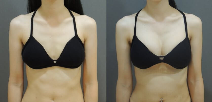 Case 11: 全程內視鏡腋下隆乳 | A 罩杯 ⇒ D 罩杯1