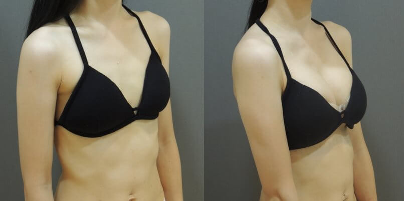 Case 11: 全程內視鏡腋下隆乳 | A 罩杯 ⇒ D 罩杯4