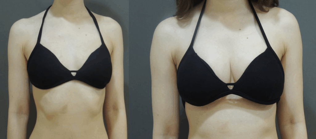 Case 12: 全程內視鏡腋下隆乳 | AA 罩杯 ⇒ 大 C 罩杯1