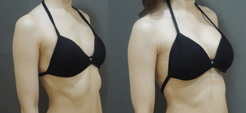 Case 12: 全程內視鏡腋下隆乳 | AA 罩杯 ⇒ 大 C 罩杯4