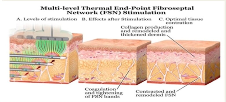 能電漿可同步緊縮 深、中、淺層纖維中膈層 (FSN)