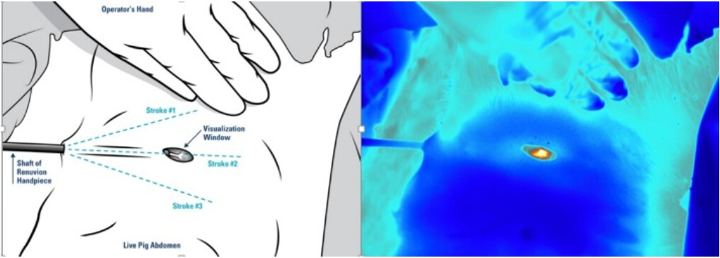 獨特氦氣冷凝系統，監控溫度安全不燙傷