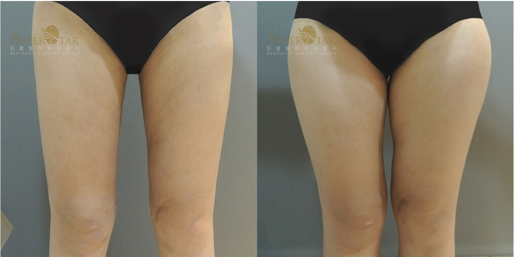 Case 1 電漿抽脂 - 大腿環抽
