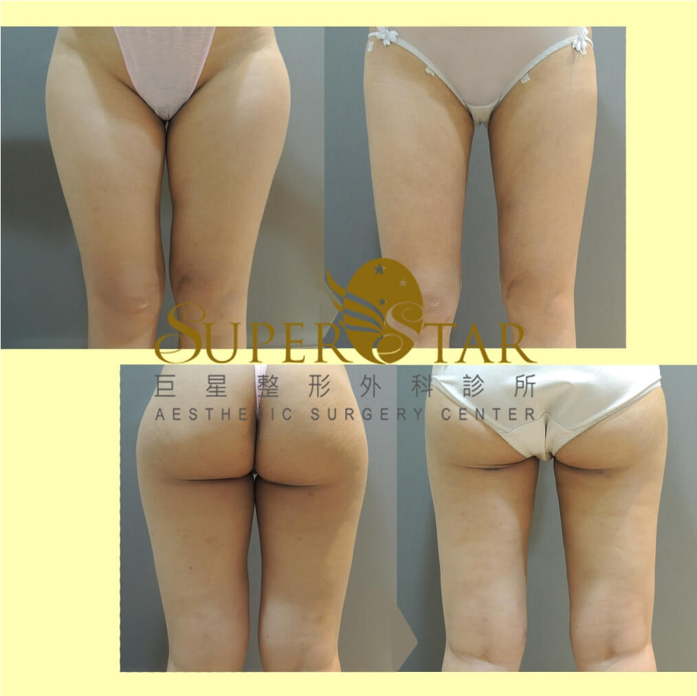 複合式電漿抽脂 - 大腿、馬鞍、臀下線