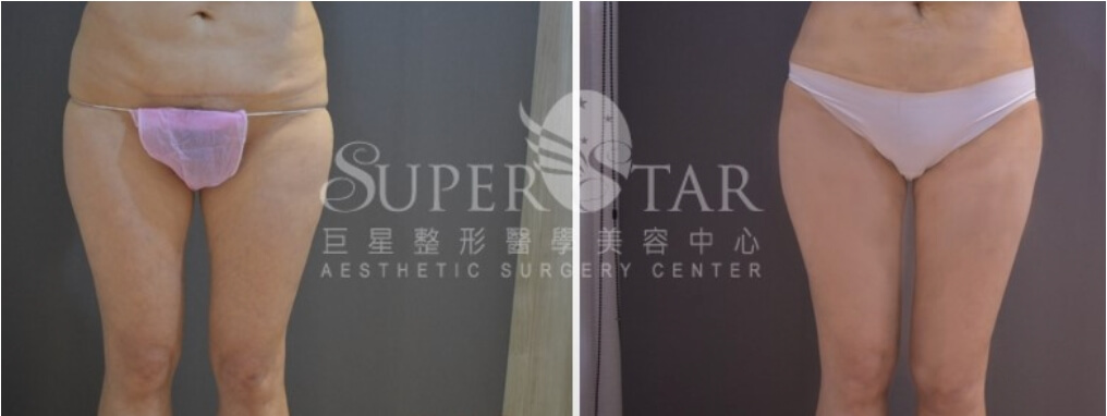 Case 3 超能電漿縮皮手術 - 大腿內側緊緻