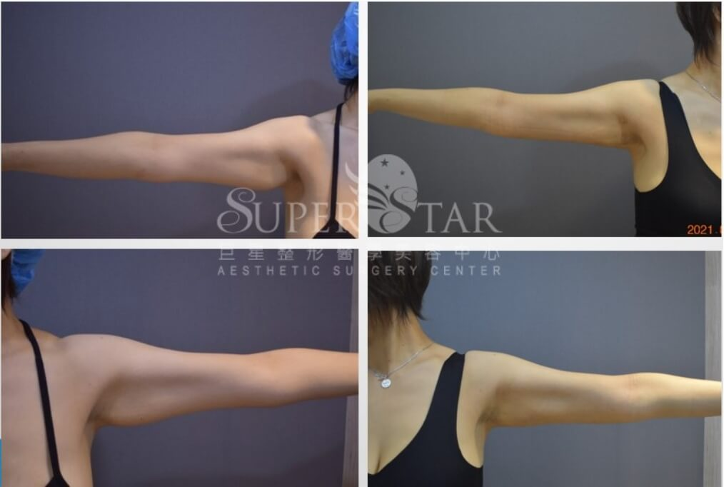 Case 5 超能電漿縮皮手術 - 手臂蝴蝶袖