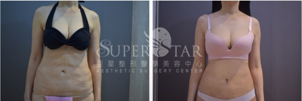 Case 6 超能電漿縮皮 - 產後腹部