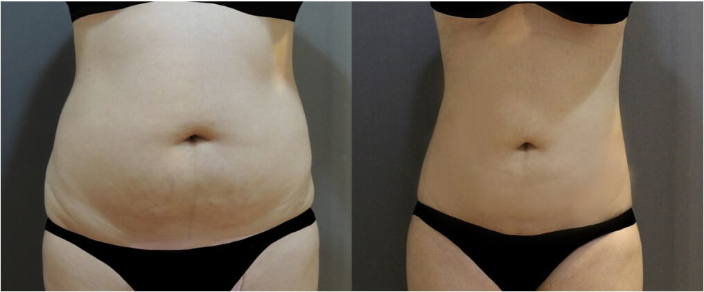 Case 7 電漿抽脂 + 超能電漿縮皮 - 腹部雕塑