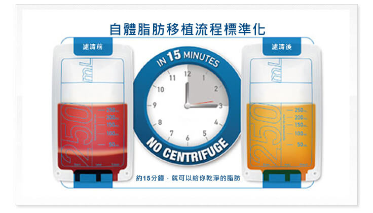自體脂肪移植標準化流程