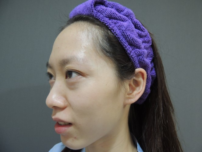 術前：正看側看，眼袋明顯