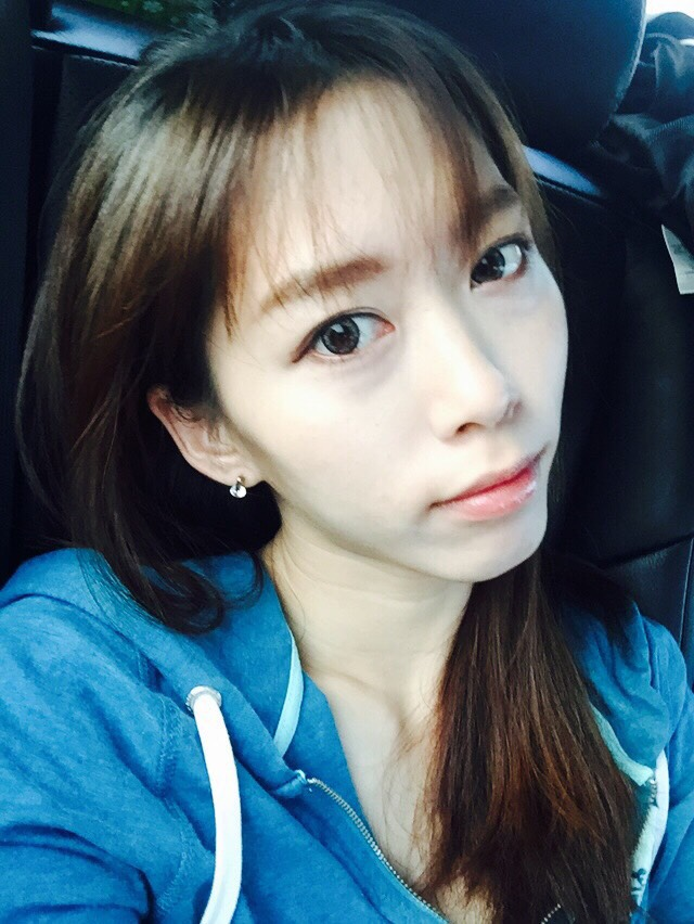 術前臉頰凹陷, 額頭平坦, 眉骨骨感明顯, 太陽穴處凹陷