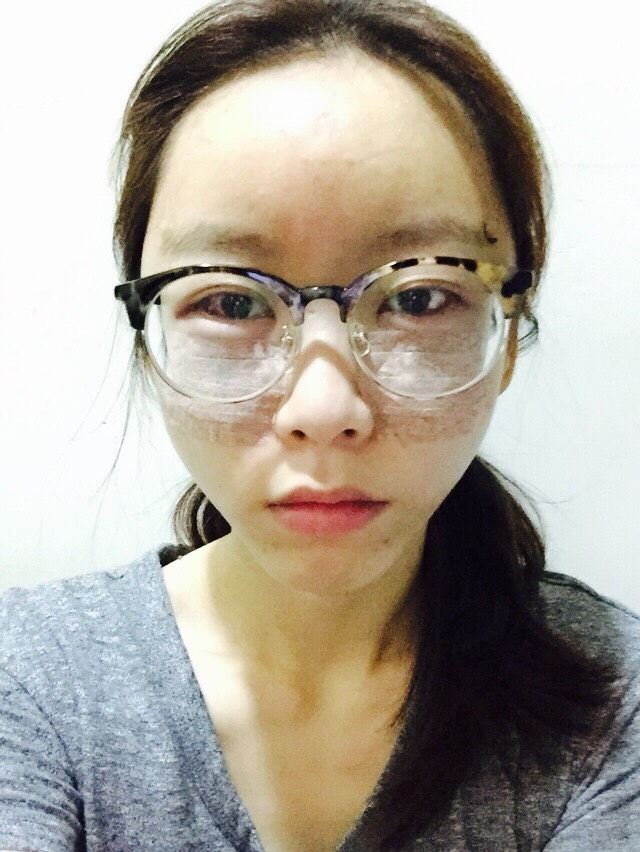 手術後隔天 ~ 額頭凸凸的