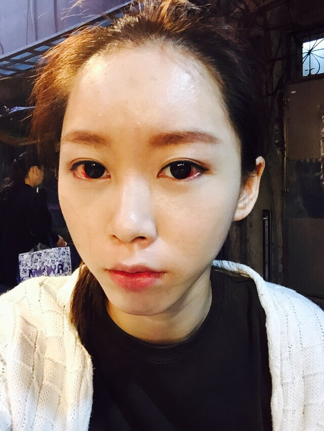 手術後兩週：額頭還是有點凸凸的，但飽滿好看