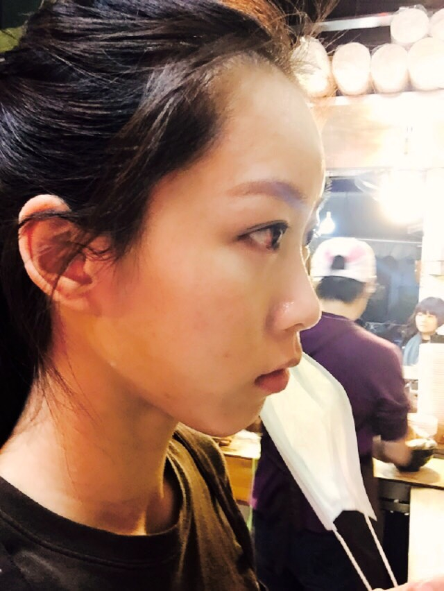 手術後兩週：額頭還是有點凸凸的，但飽滿好看