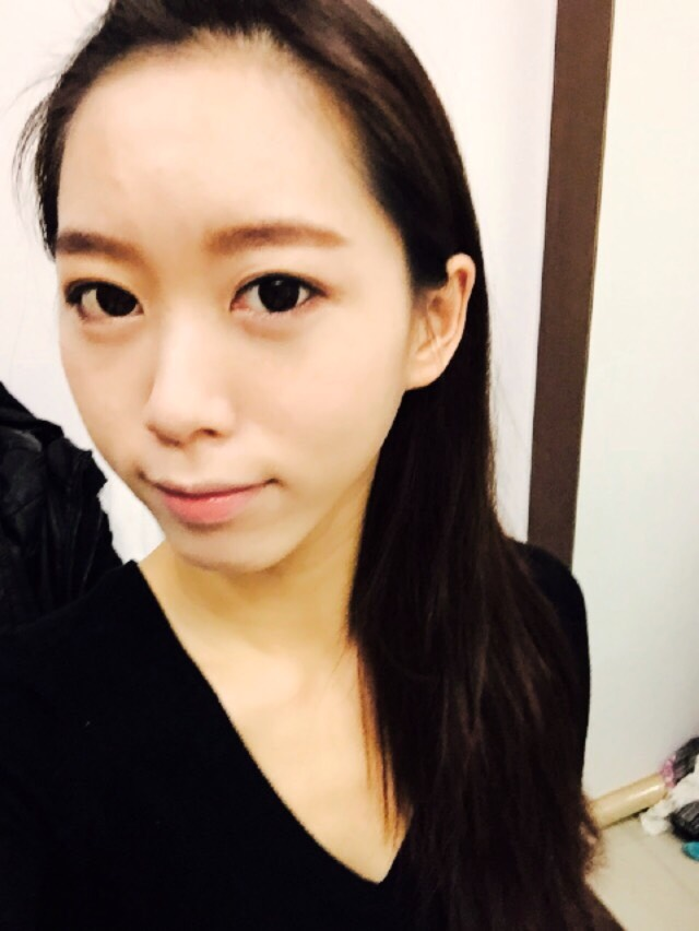 手術後三週：越來越自然