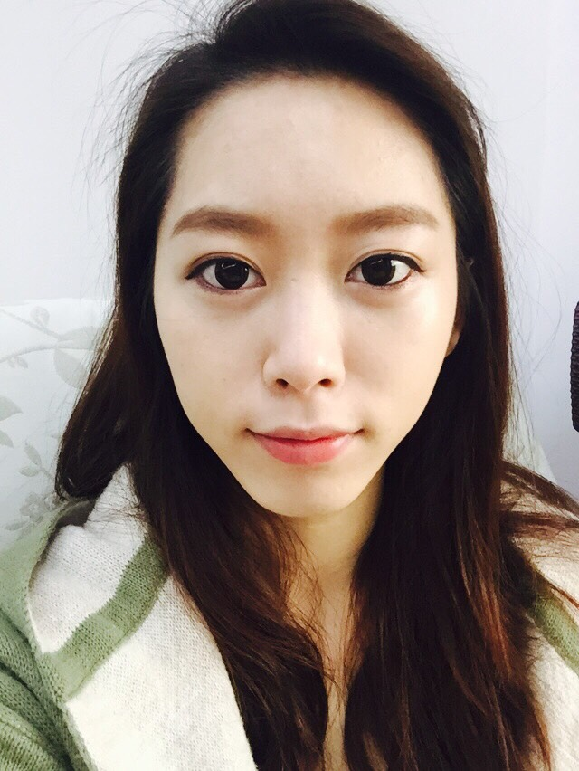 手術後一個月：臉頰豐潤，額頭飽滿，眼袋也不見了