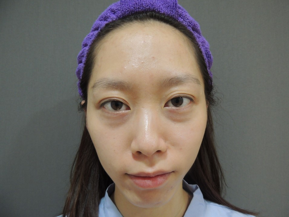 術前：正看側看，眼袋明顯