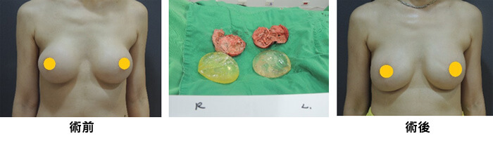 術前術後對比圖