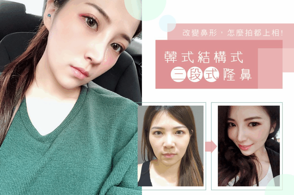 結構式隆鼻與二段式隆鼻案例分享