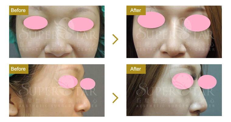 Case 1：人工骨韓式隆鼻