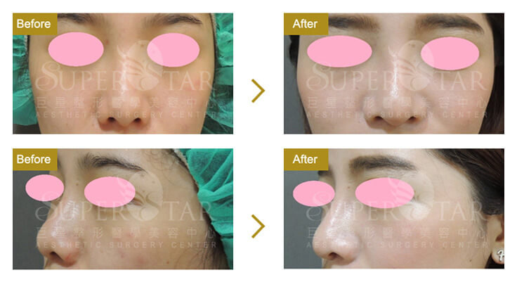 Case 2：人工骨韓式隆鼻