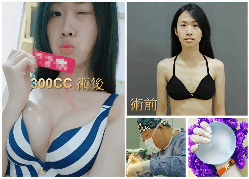 隆乳手術術後案例分享-身形雕塑效果