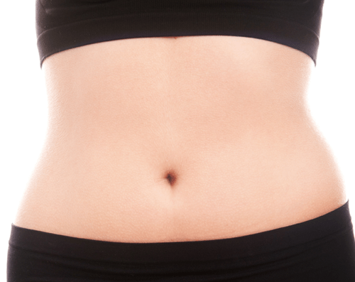 威塑腹部抽脂案例1