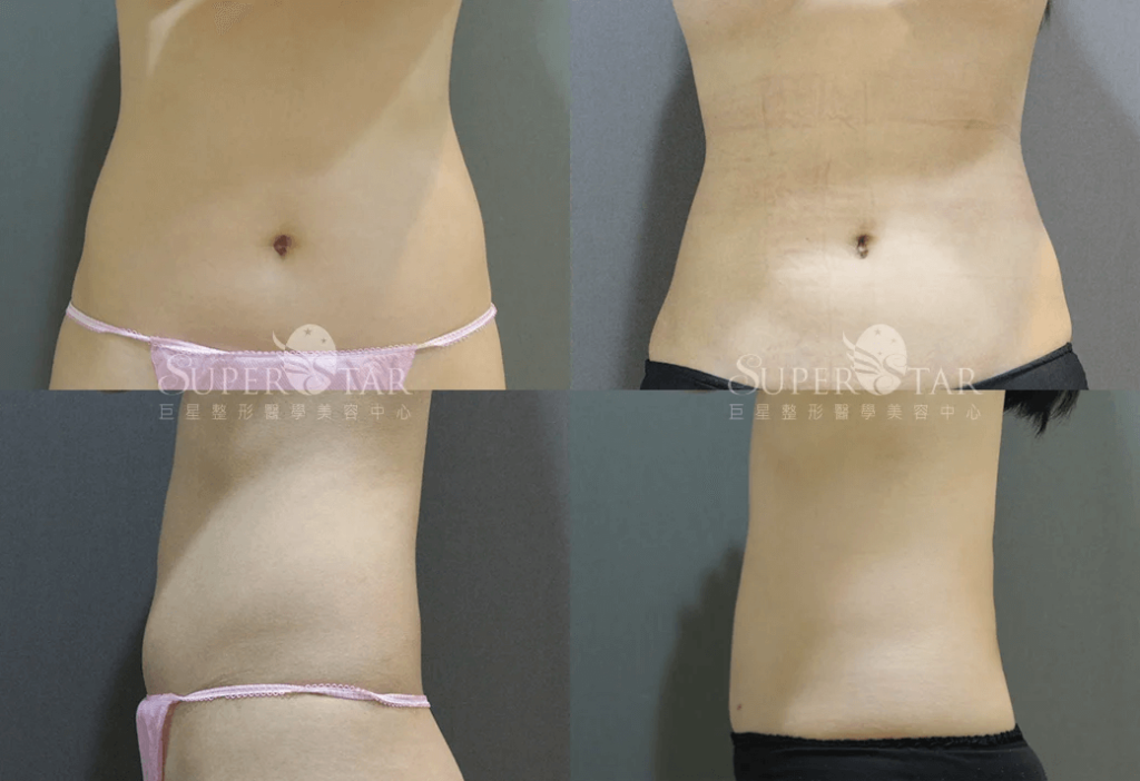 威塑腹部抽脂案例2