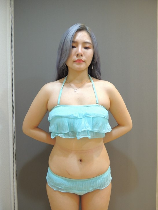 術前紀錄，正面。