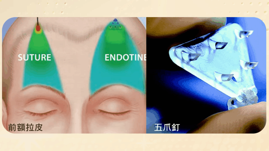五爪釘固定原理