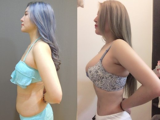 威塑抽脂術後, 腹部抽脂側面比較