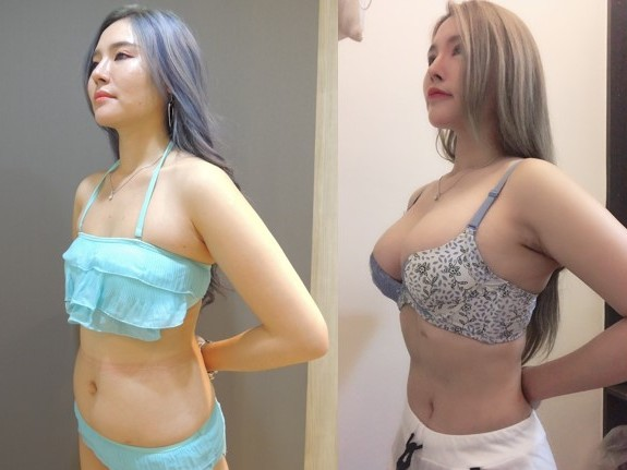 威塑抽脂術後, 腹部抽脂側面比較