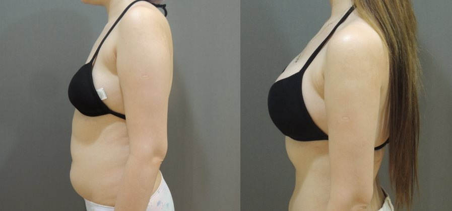 威塑抽脂與隆乳案例3-3