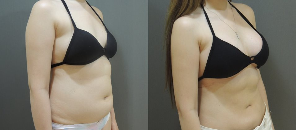 威塑抽脂與隆乳案例3-4