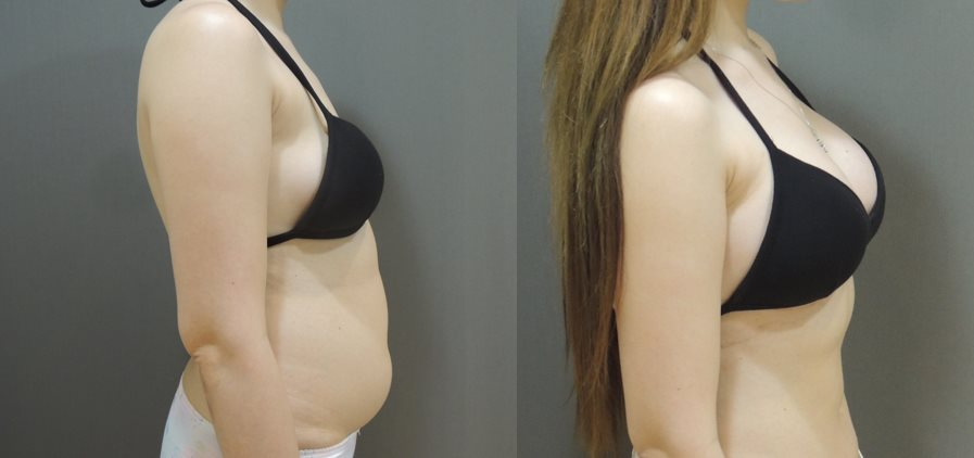 威塑抽脂與隆乳案例3-5