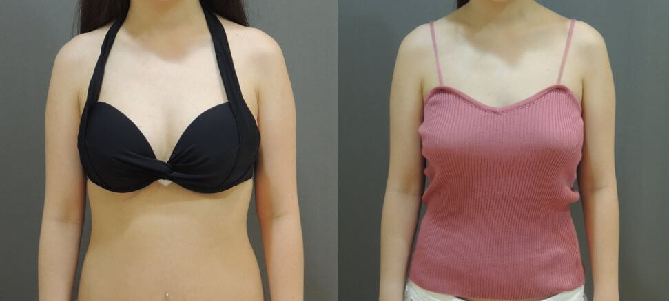 自體脂肪隆乳術後大變身：豐滿曲線呼之欲出